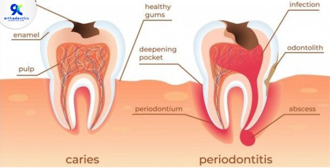 gejala gigi perlubang